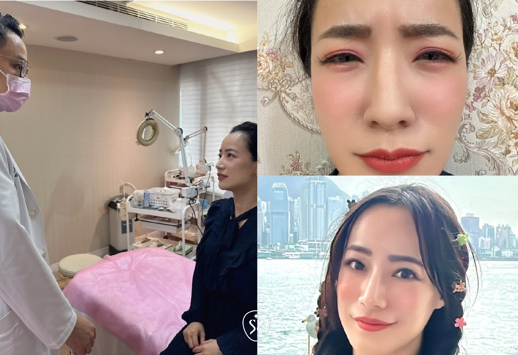 【肉毒除皺】